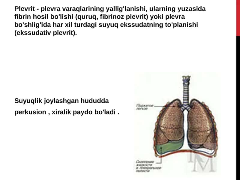 Plevritning tasnifi 1
