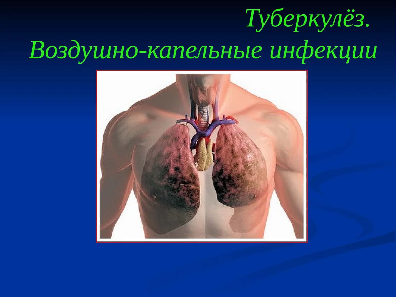Туберкулёз.Воздушно-капельные инфекции 1