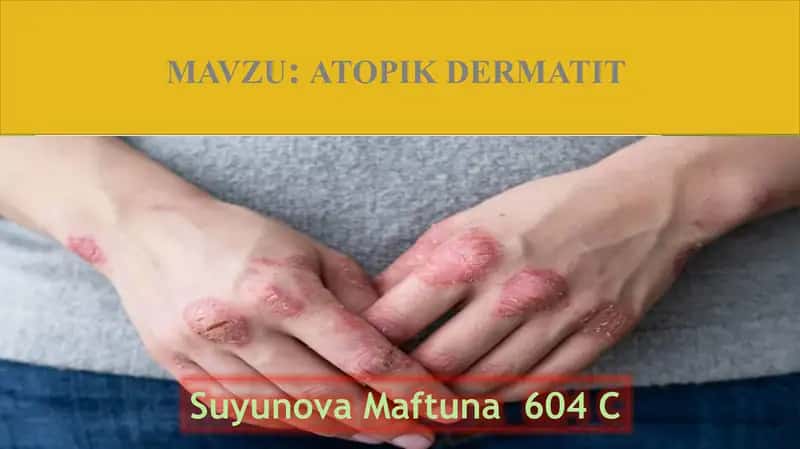 ATOPIK DERMATIT 1