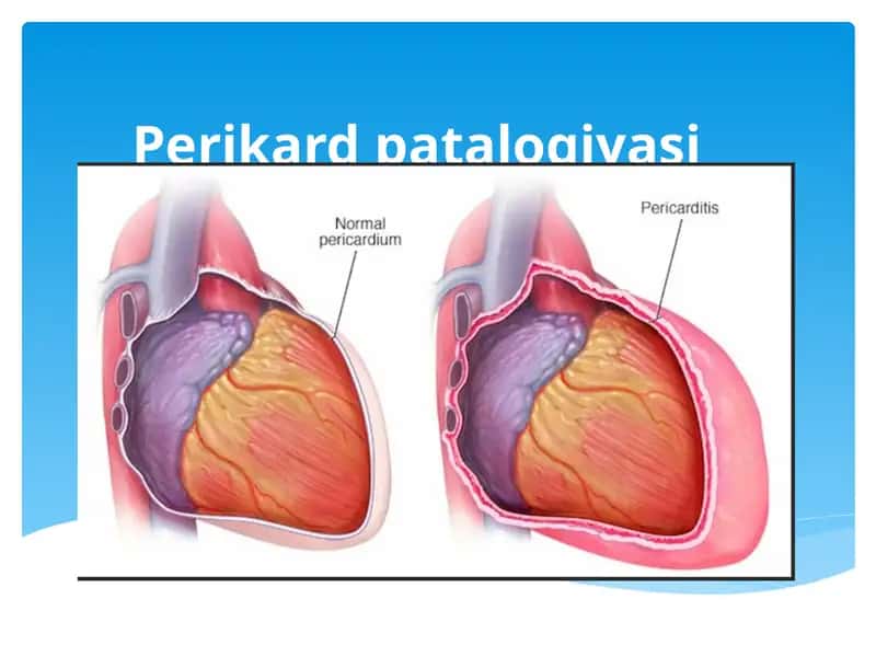 Perikardpatalogiyasi 1