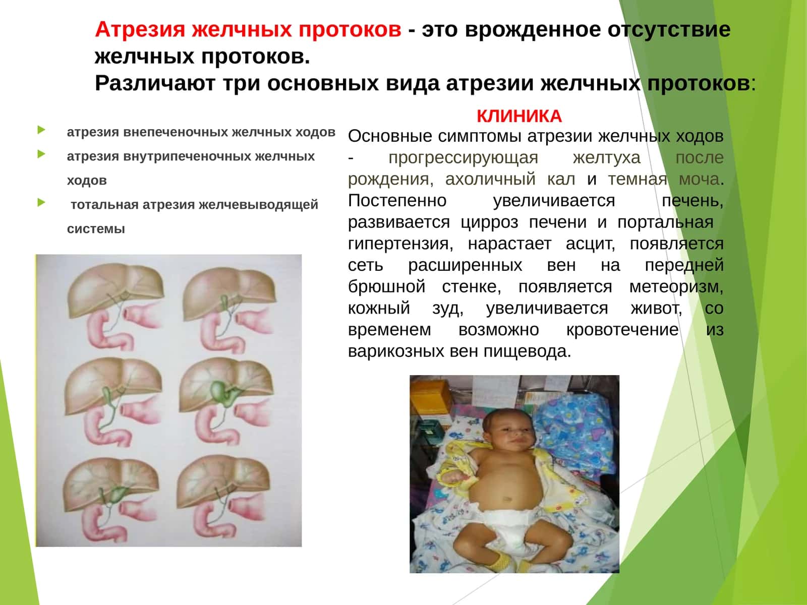 Атрезия желчных протоков 1