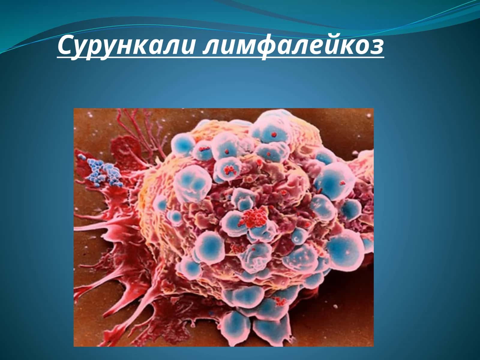 Сурункали лимфалейкоз 1