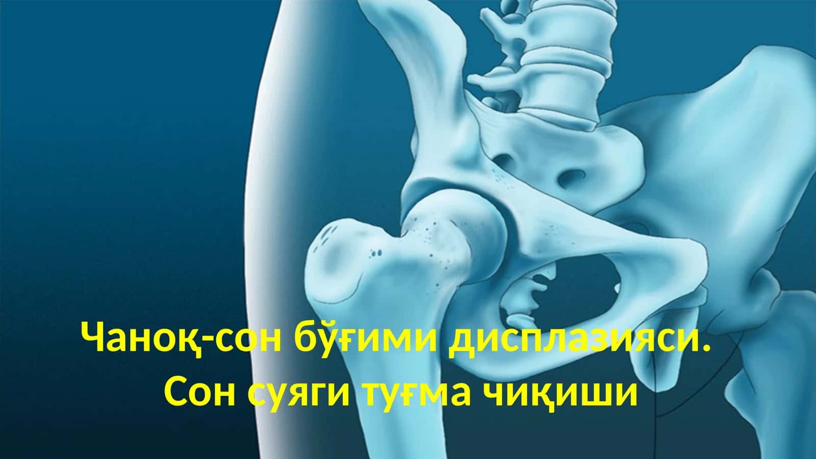 Чаноқ-сон бўғими дисплазияси 1