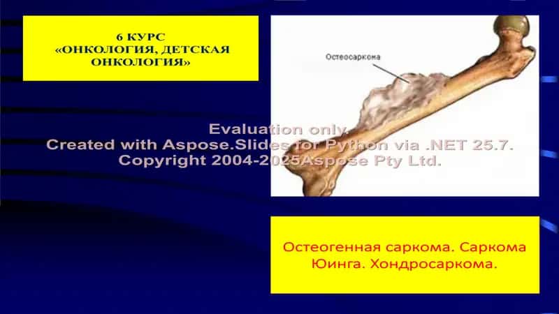 Злокачественные опухоли костей (rus) 1