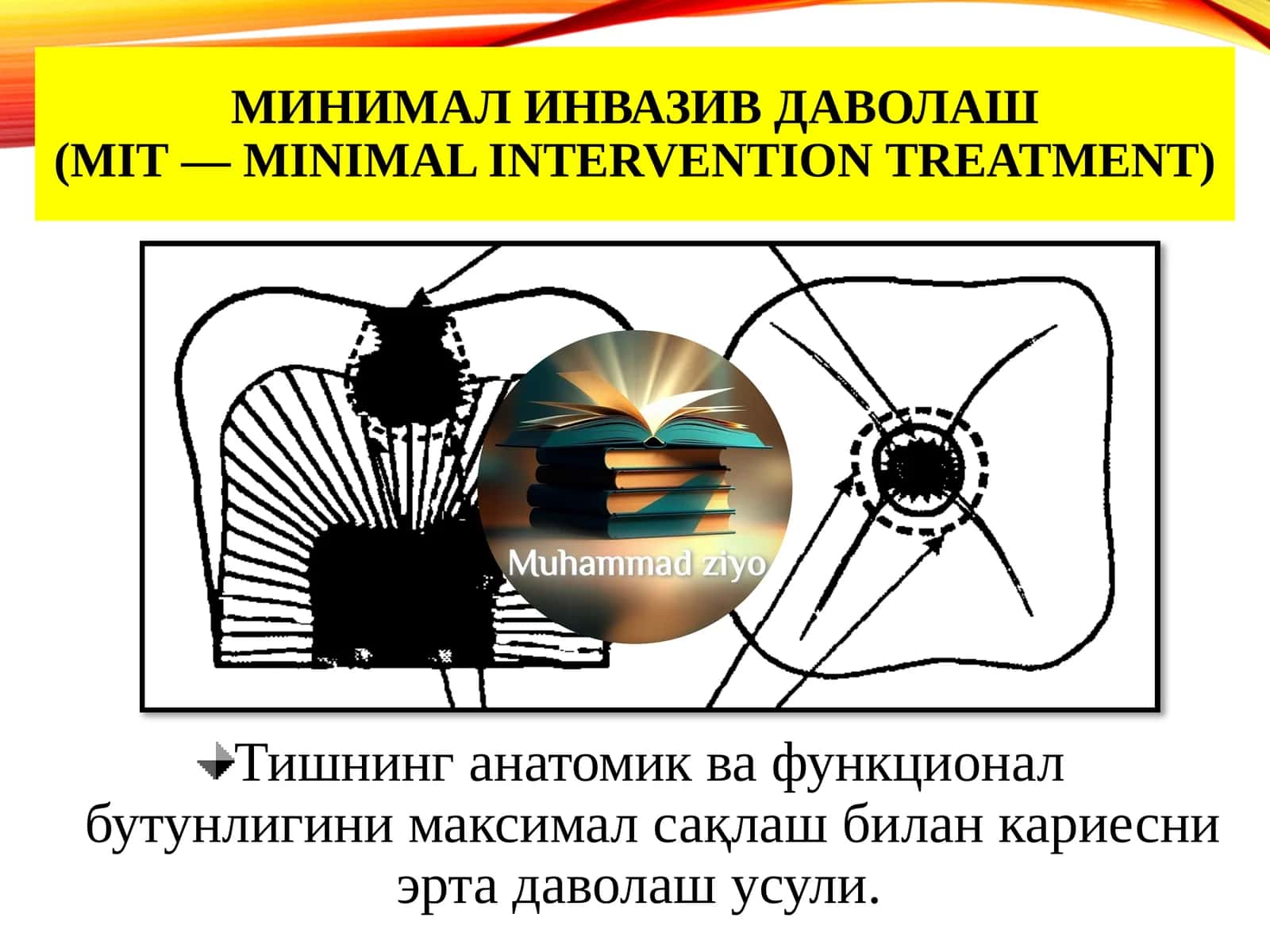МИНИМАЛ ИНВАЗИВ ДАВОЛАШ(MIT—minimal interventiontreatment) 1