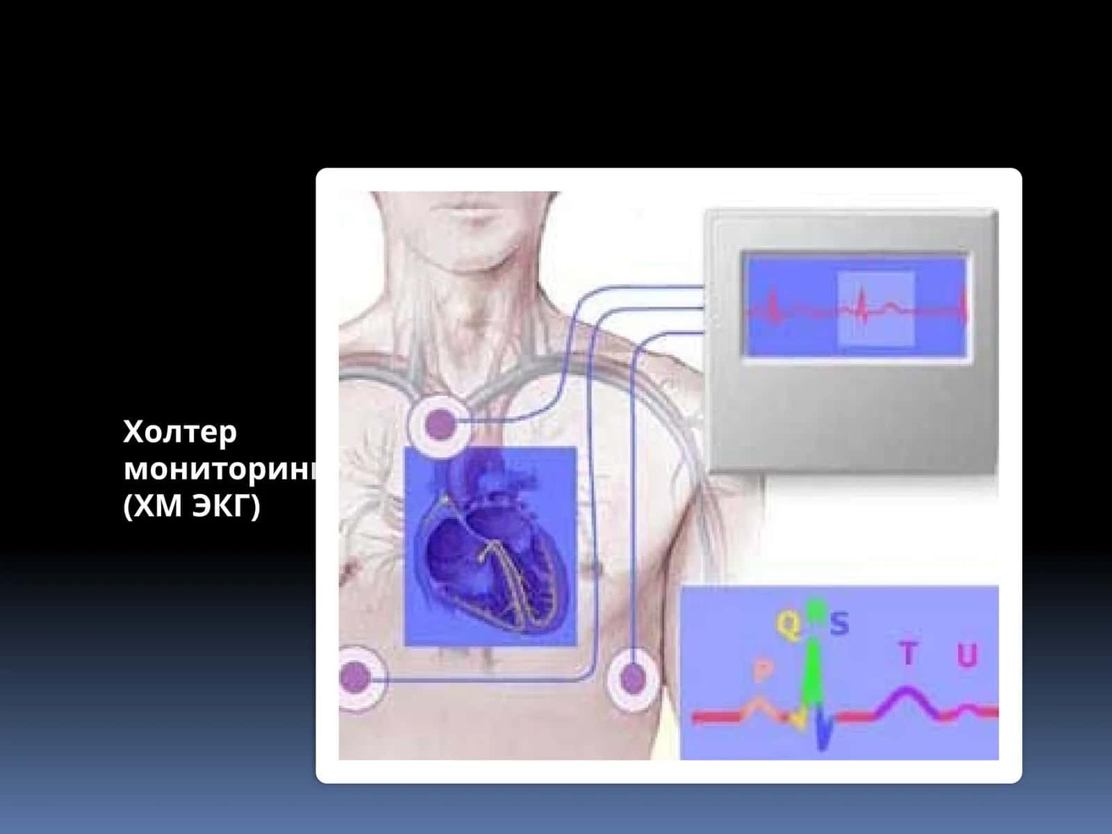 Холтермониторинги (ХМ ЭКГ) 1