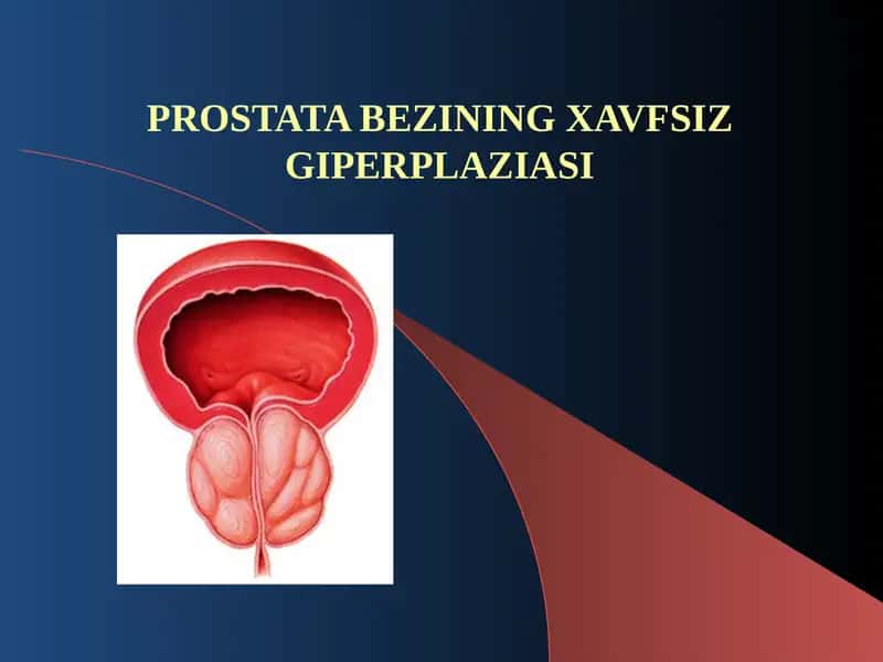 PROSTATA BEZININGXAVFSIZ GIPERPLAZIASI 1