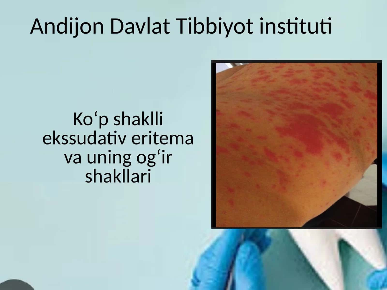 Ko‘p shaklli ekssudativ eritema va uning og‘ir shakllari 1