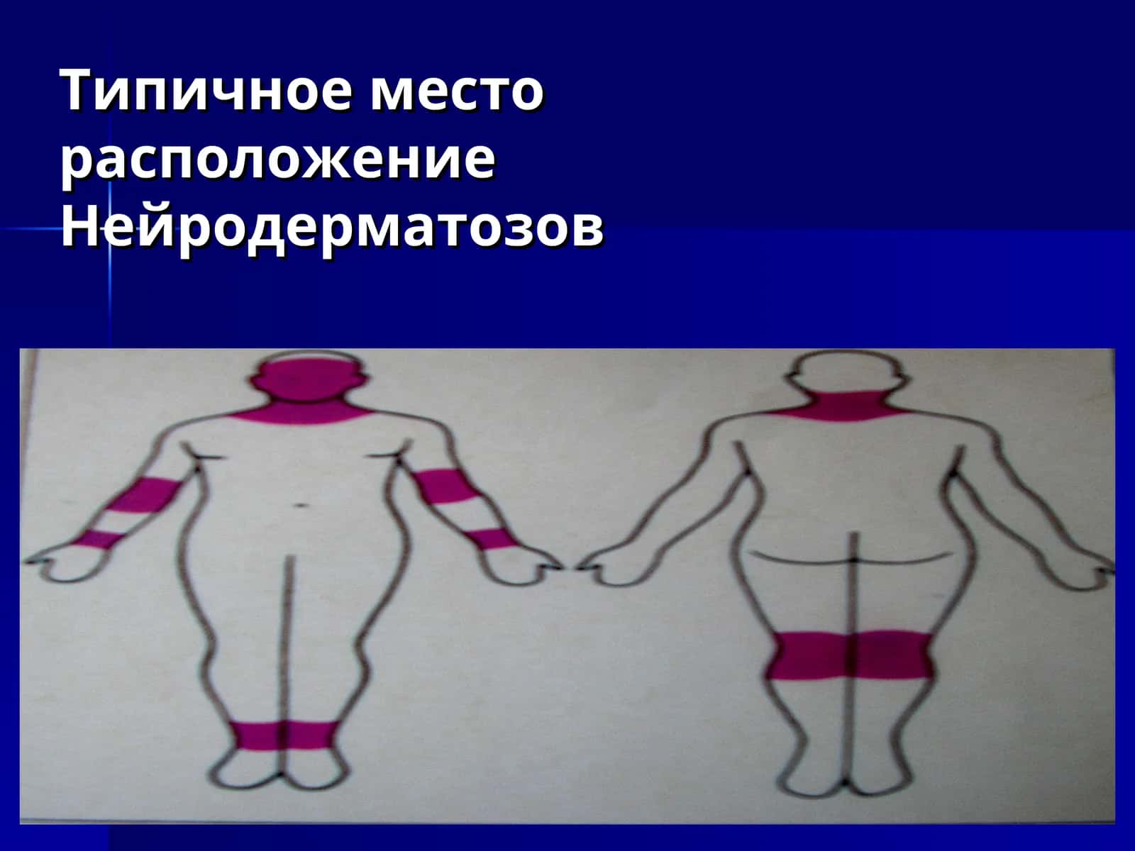 Нейродерматозов 1