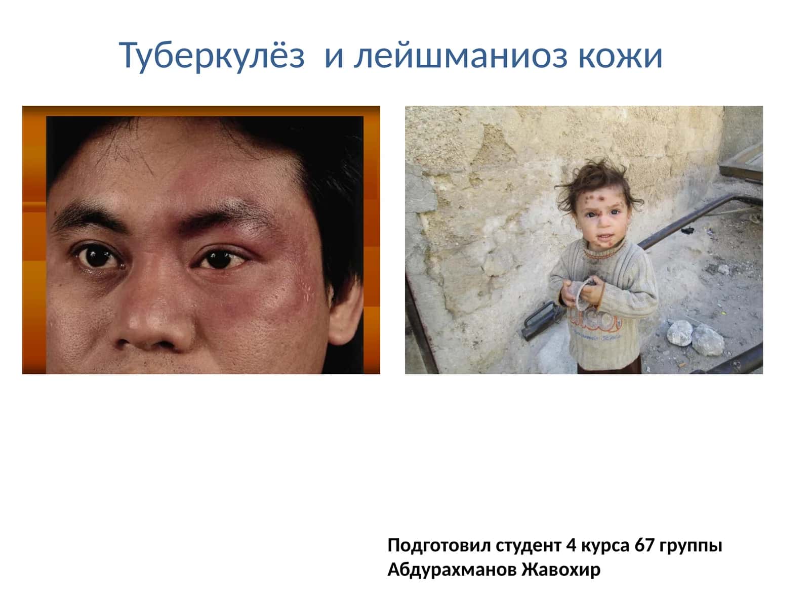 Туберкулёз и лейшманиоз кожи 1
