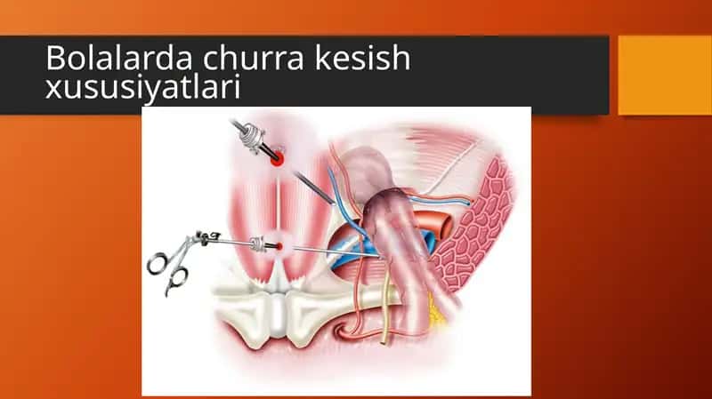 Bolalarda churra kesish xususiyatlari 1