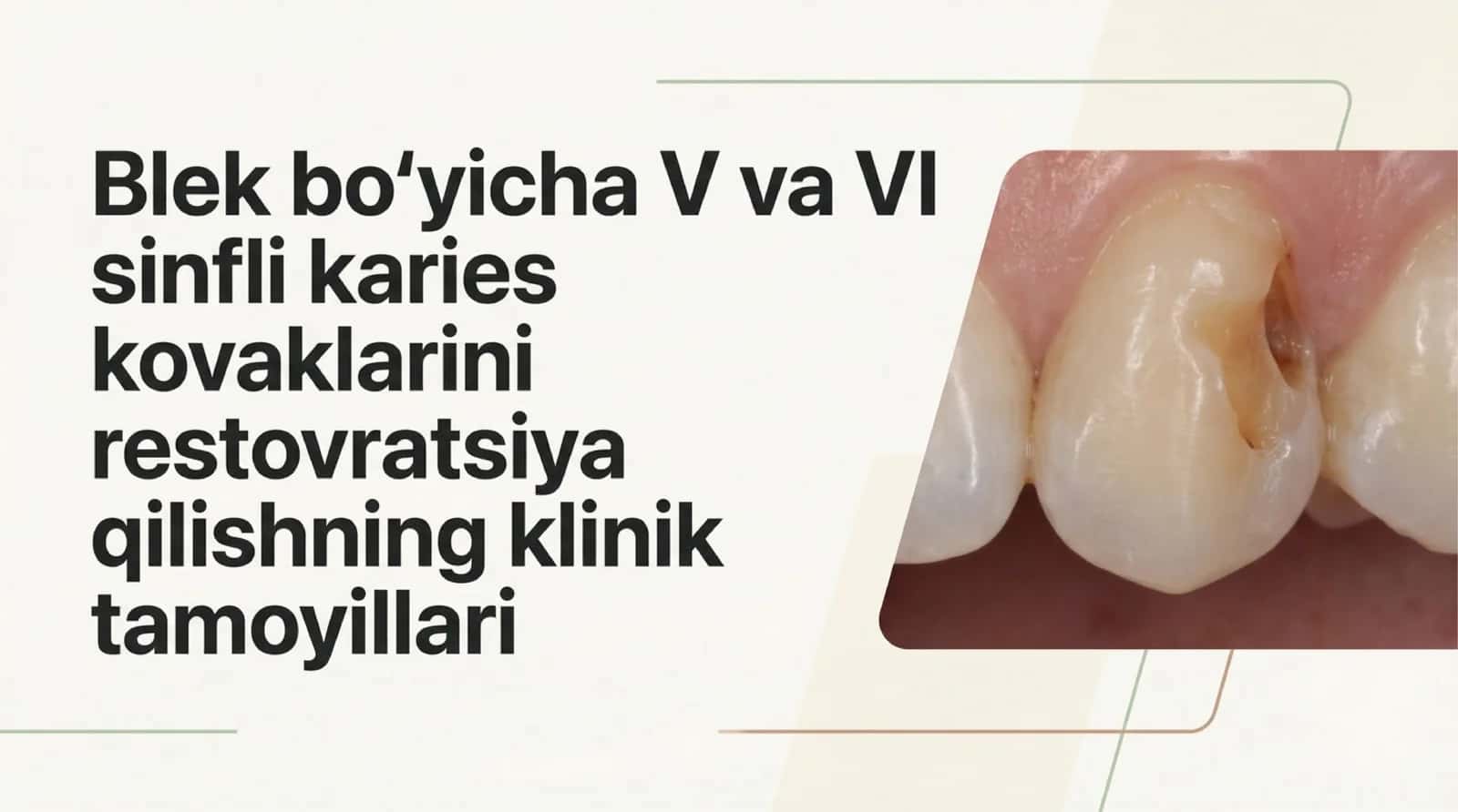Blek boʻyicha V , VI sinfli karies kovaklarini restovratsiya qilishning klinik tamoyillari 1