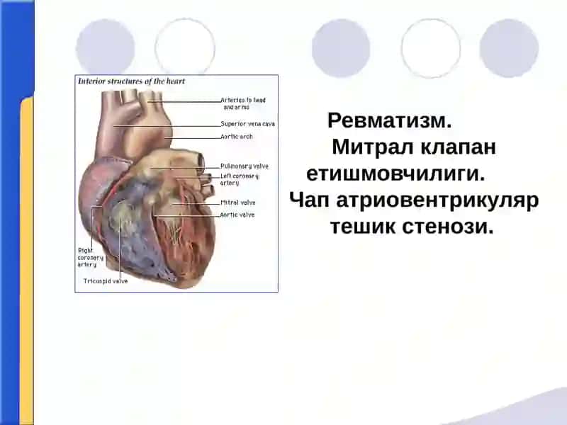 Ревматизм