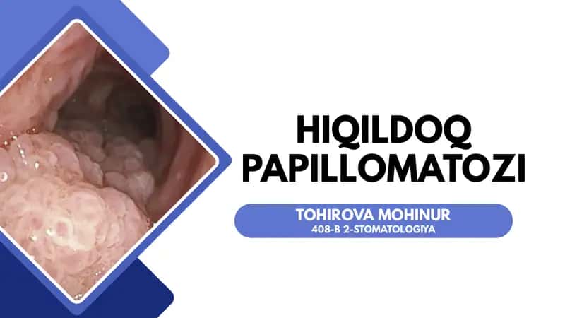 Hiqildoq papillomasi 1