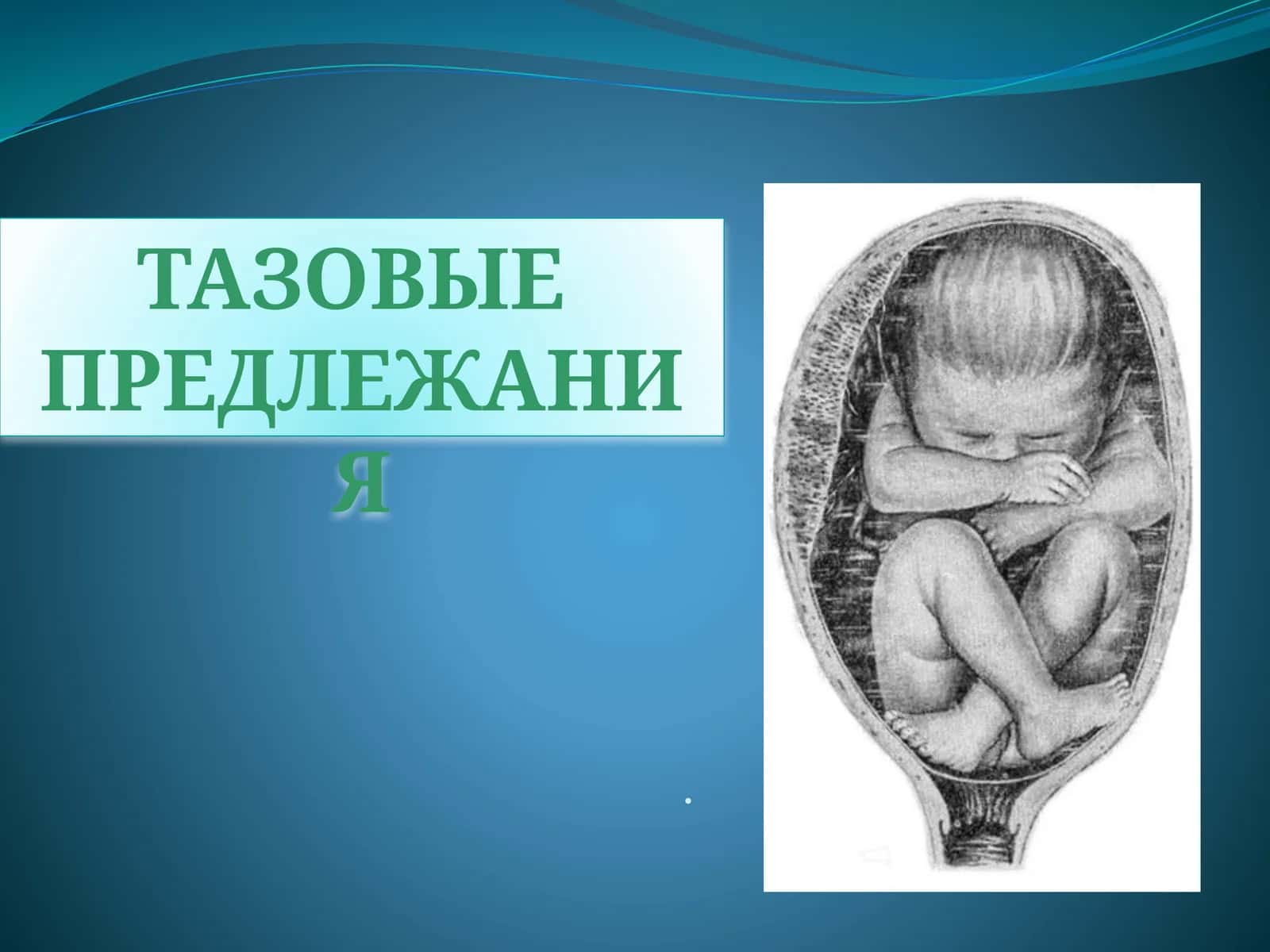 Тазовые предлежания 1