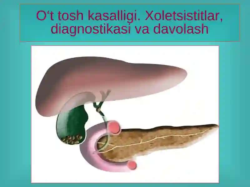 O‘t tosh kasalligi. Xoletsistitlar, diagnostikasi va davolash