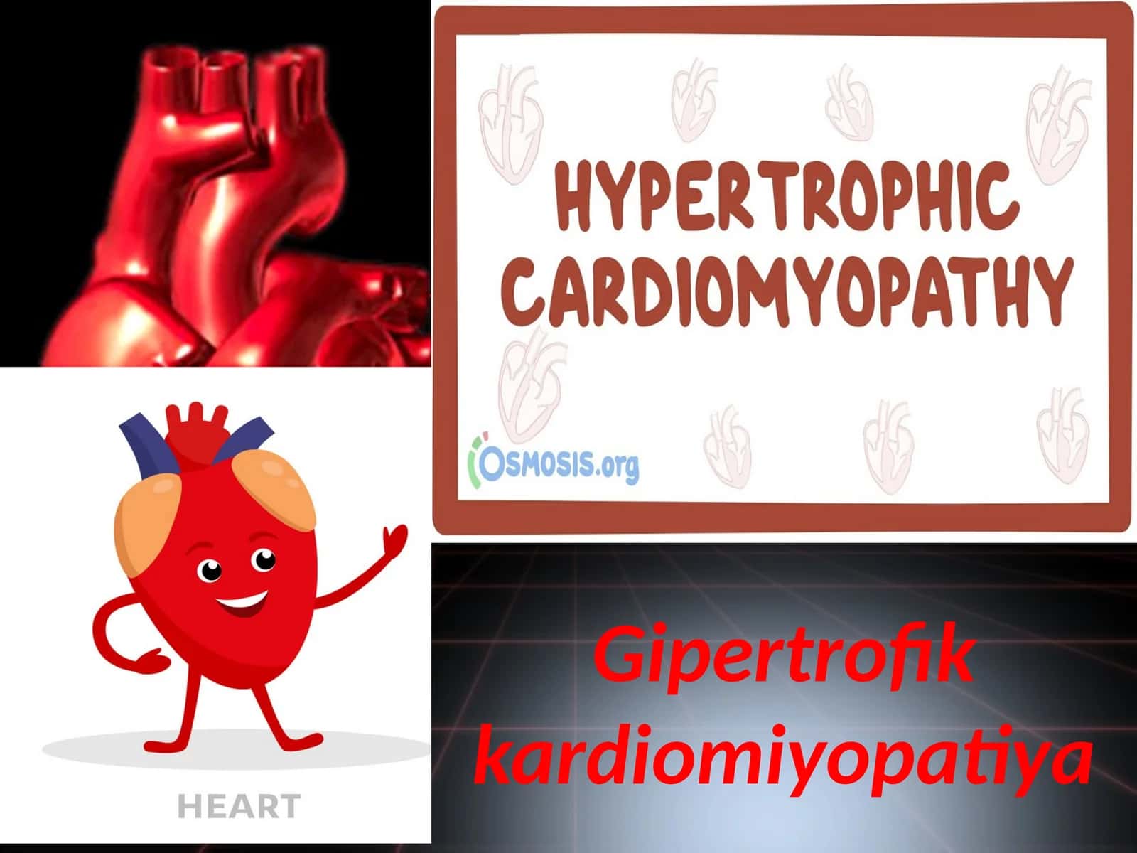 Gipertrofik kardiomiyopatiya 1