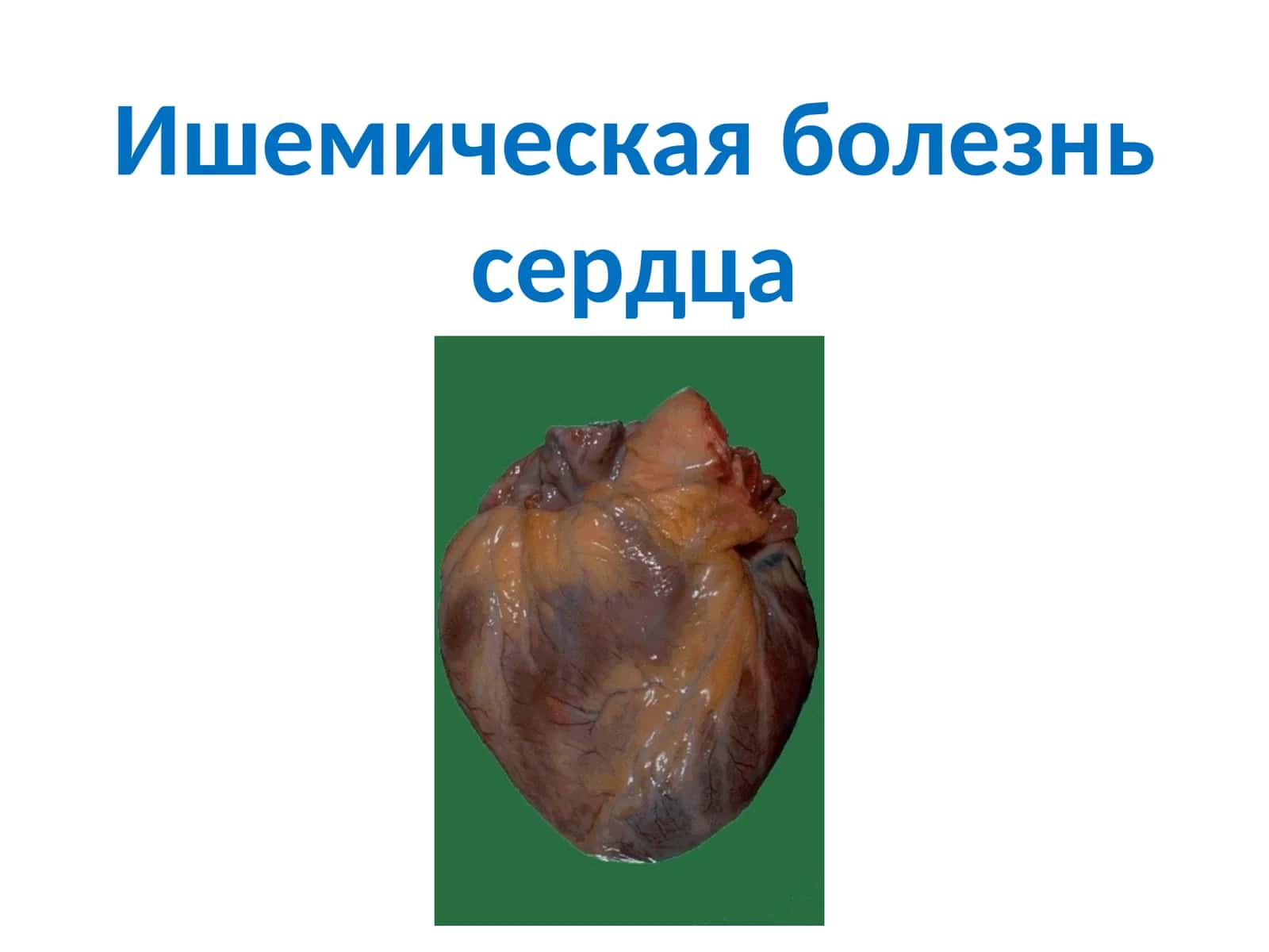 Ишемическая болезнь сердца 1
