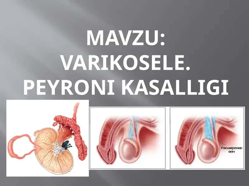 Varikosele 1