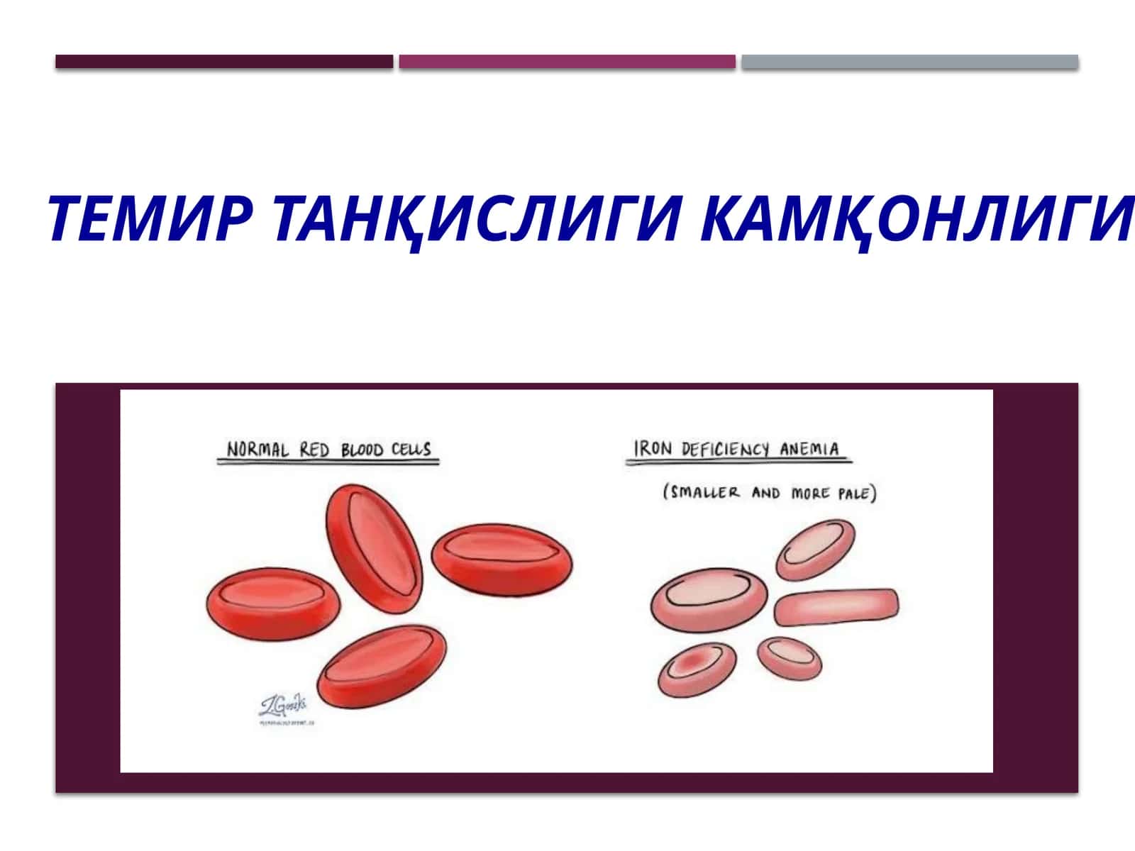 Темир танқислиги камқонлиги 1