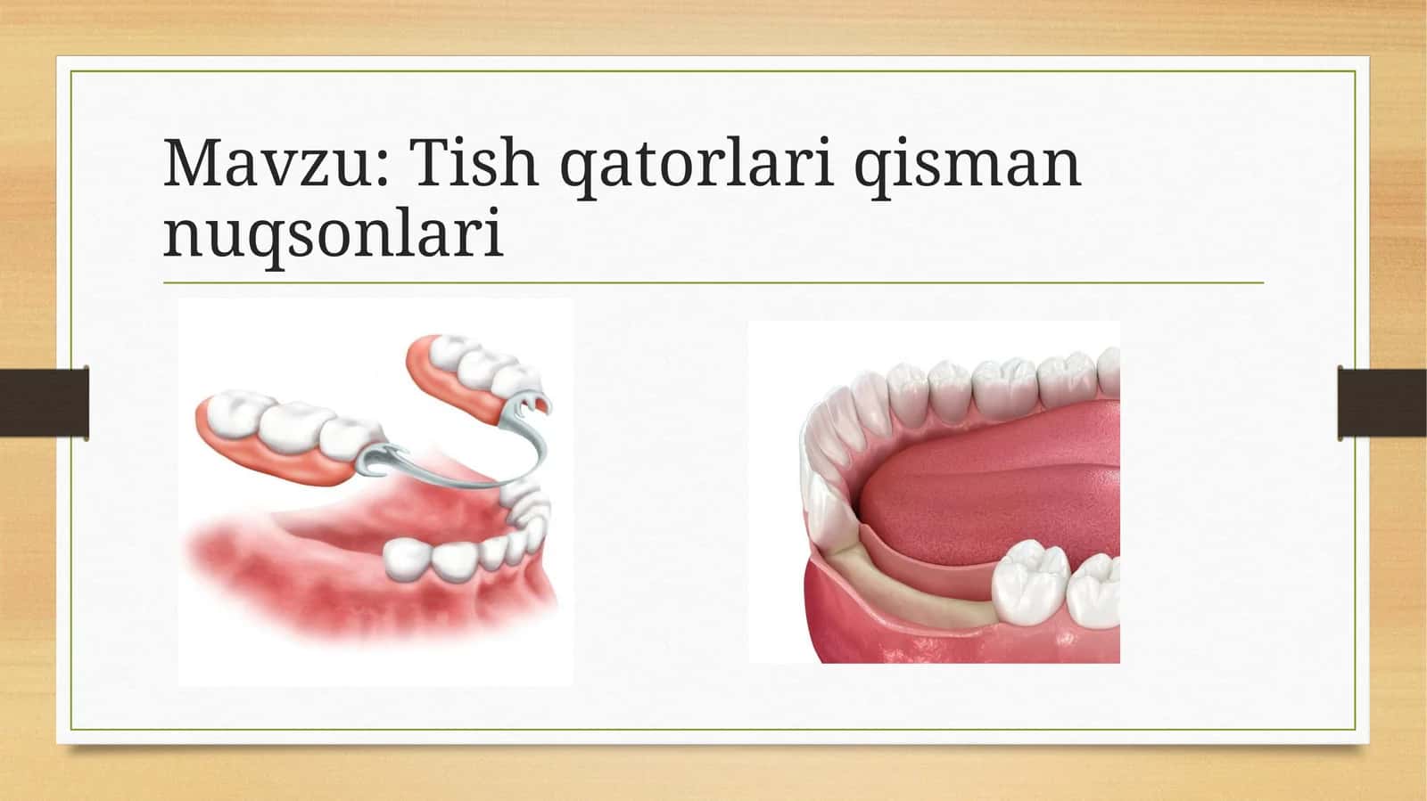 Tish qatorlari qisman nuqsonlari 1
