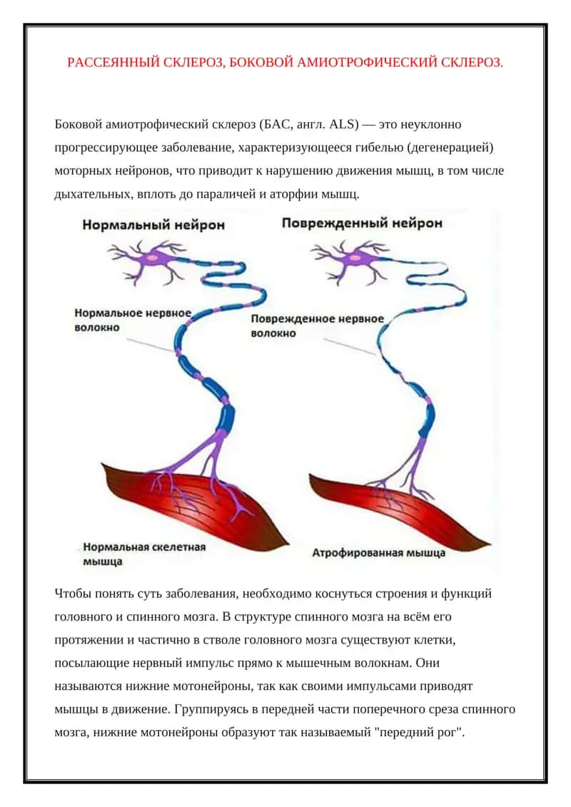 Боковой амиотрофический склероз(БАС) 1