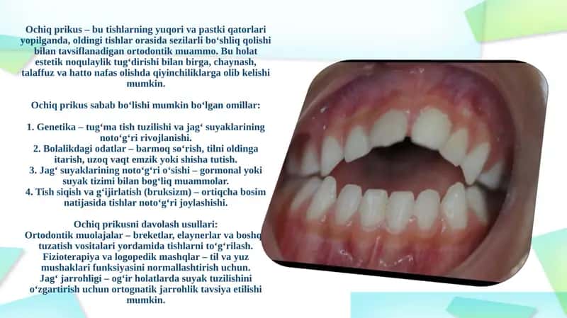 Ochiq prikus muammosi 1