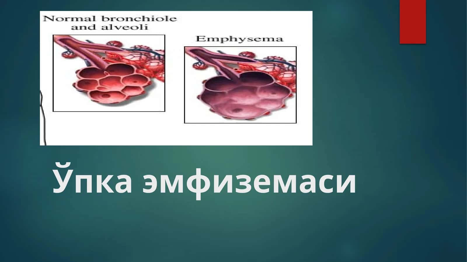Ўпка эмфиземаси (o'ka emfuzemasi) 1