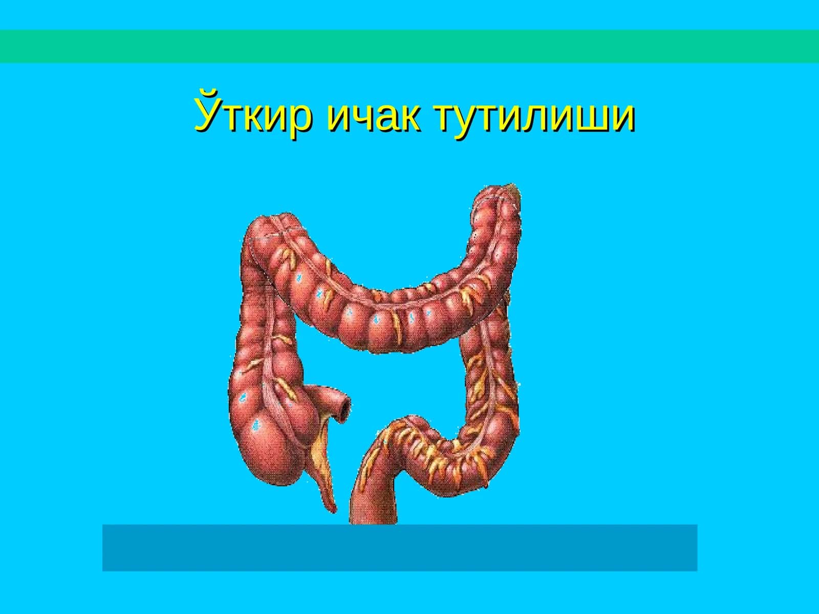 Ўткир ичак тутилиши 1