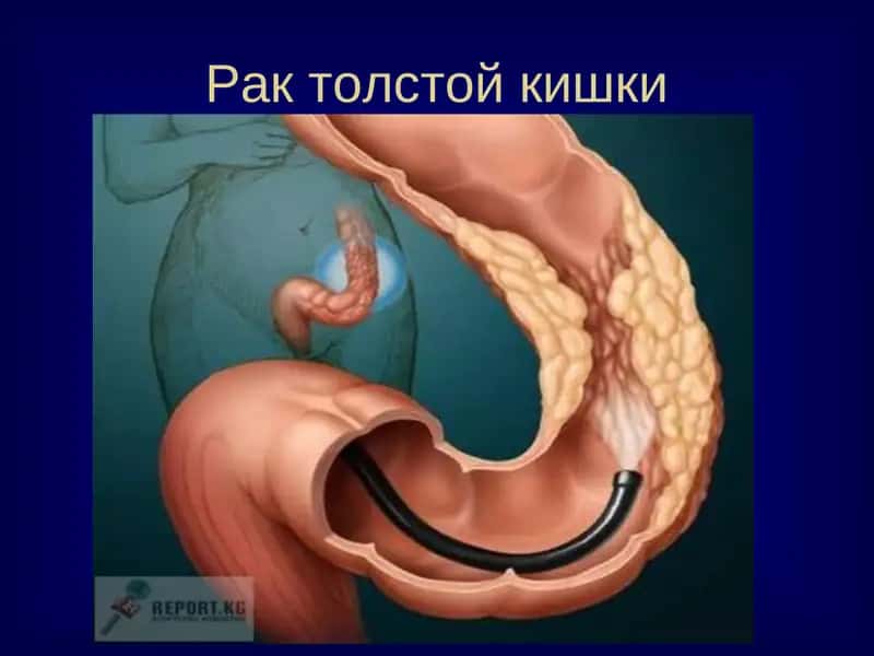 Рак толстой кишки 1