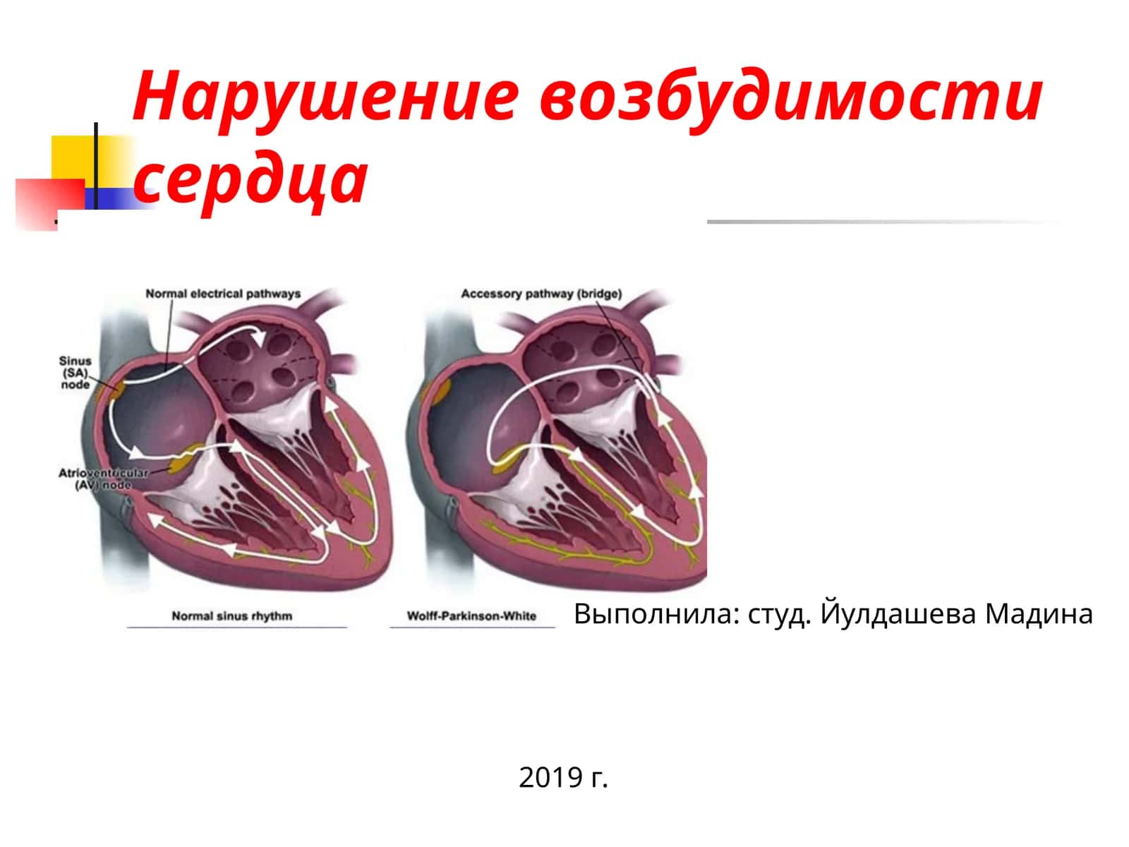 Нарушение возбудимости сердца 1