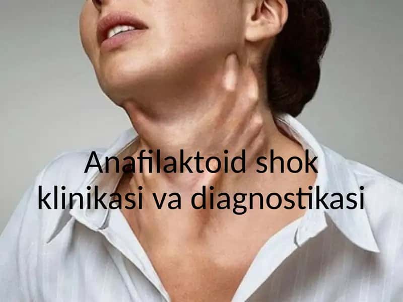 Anafilaktoid shok klinikasi  va diagnostikasi 1