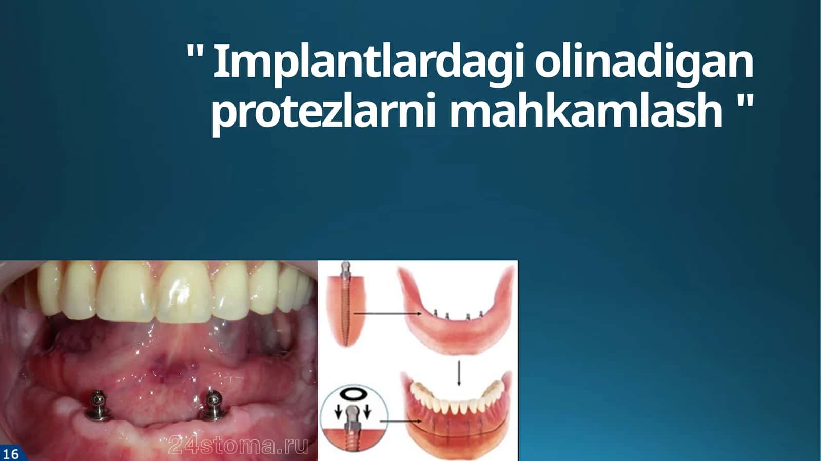 " Implantlardagi olinadigan protezlarni mahkamlash " 1
