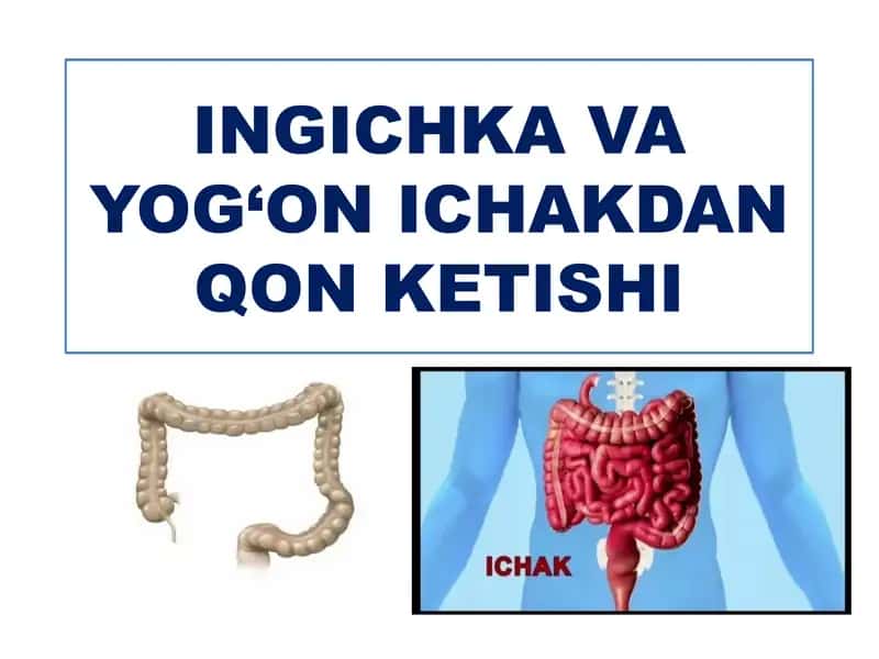 Ichakdan qon ketishi 1