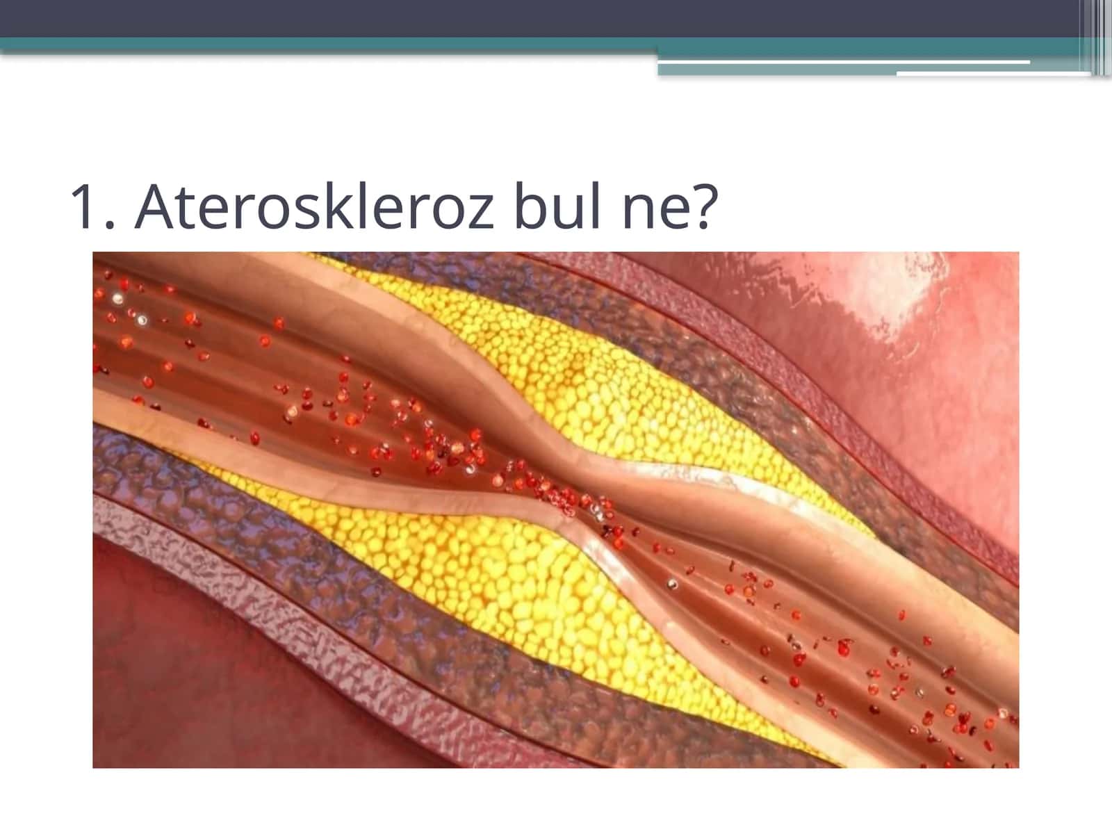 Ateroskleroz rawajlaniwi 1