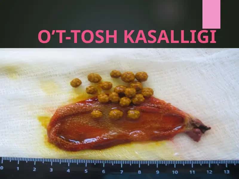 O’T-TOSH KASALLIGI 1