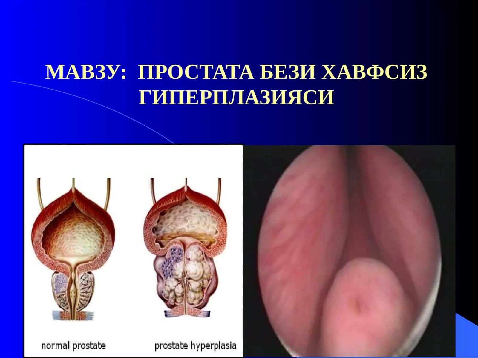 Простата бези хавфсиз гиперплазияси 1