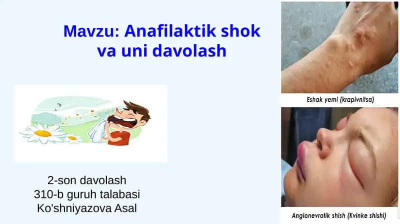 Anafilaktik shok va uni davolash 1