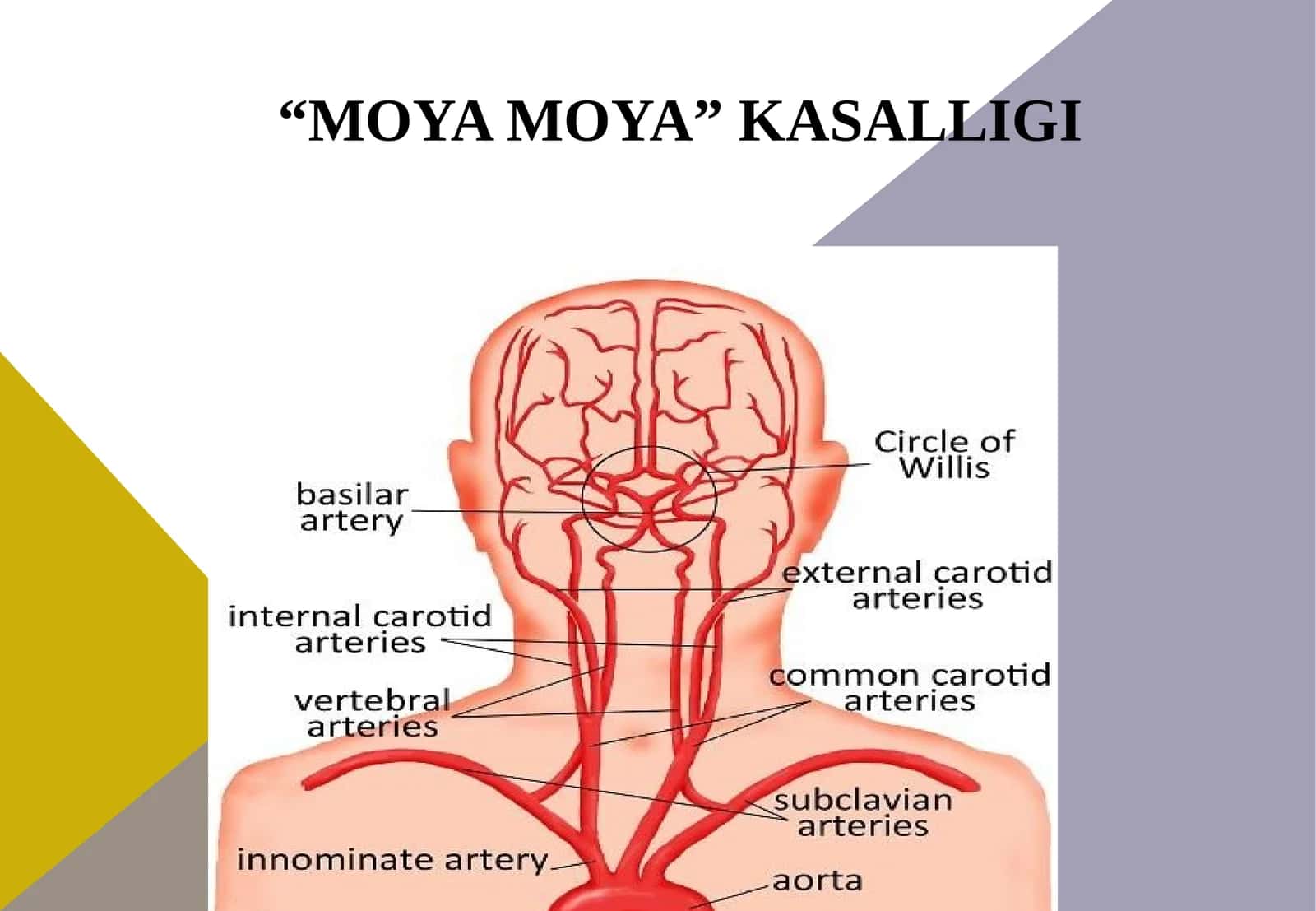 Moyamoya kasalligi 1