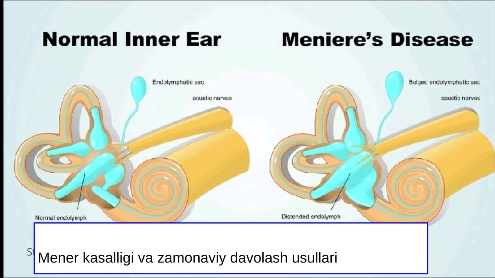 Mener kasalligi va zamonaviy davolash usullari 1