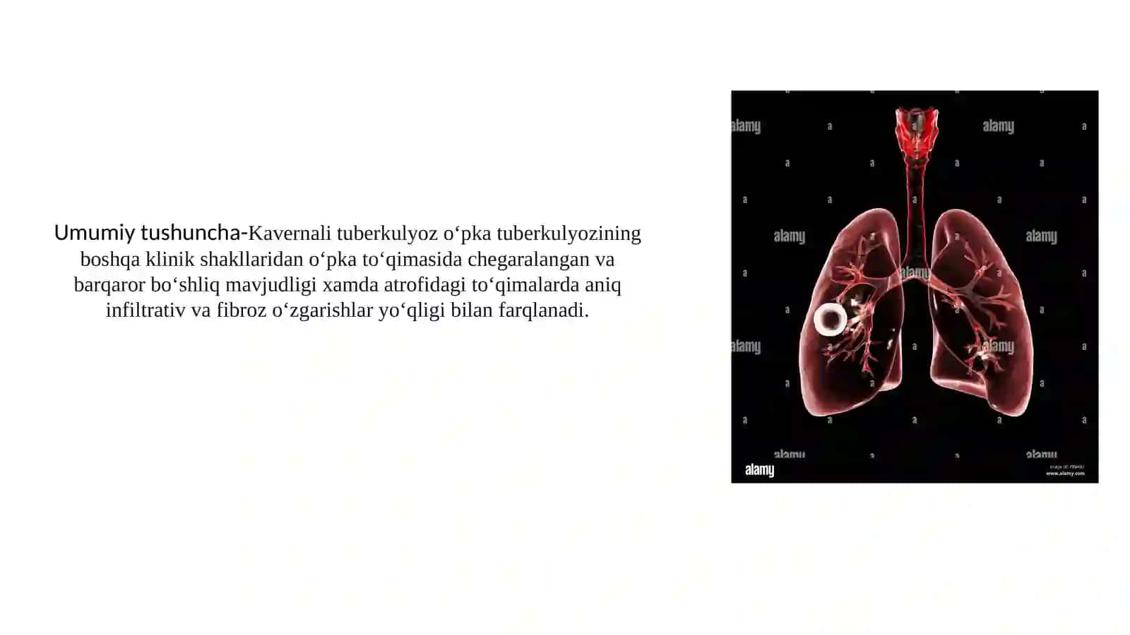 tuberkulyozni destruktiv shakllari 2