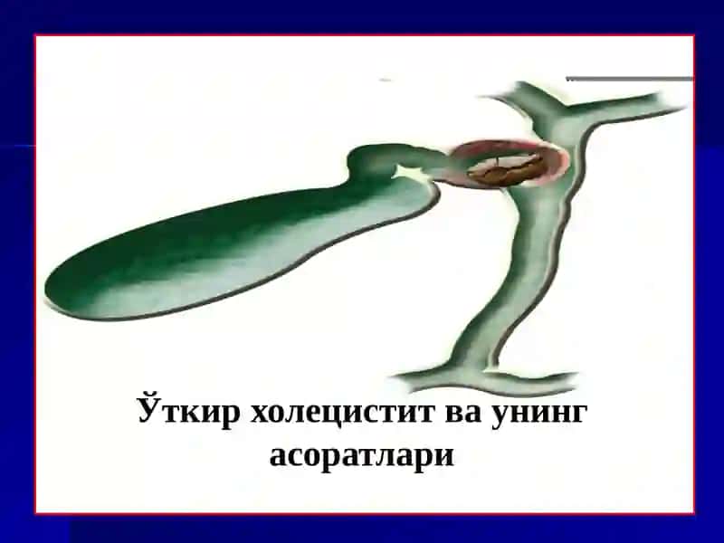 ЎТКИР ХОЛЕЦИСТИТ ВА УНИНГ АСОРАТЛАРИ 2