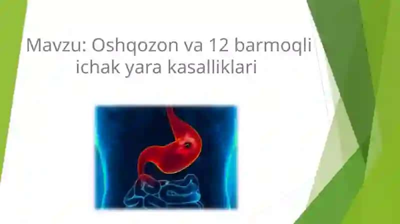 Oshqozon va 12 barmoqli ichak yara kasalliklari 2