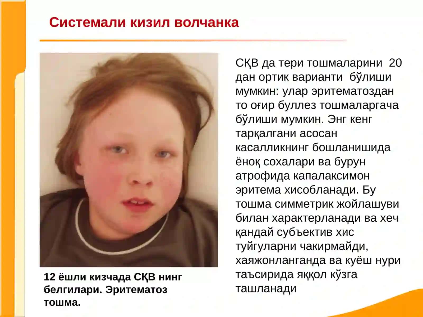 Системали кизил волчанка 2