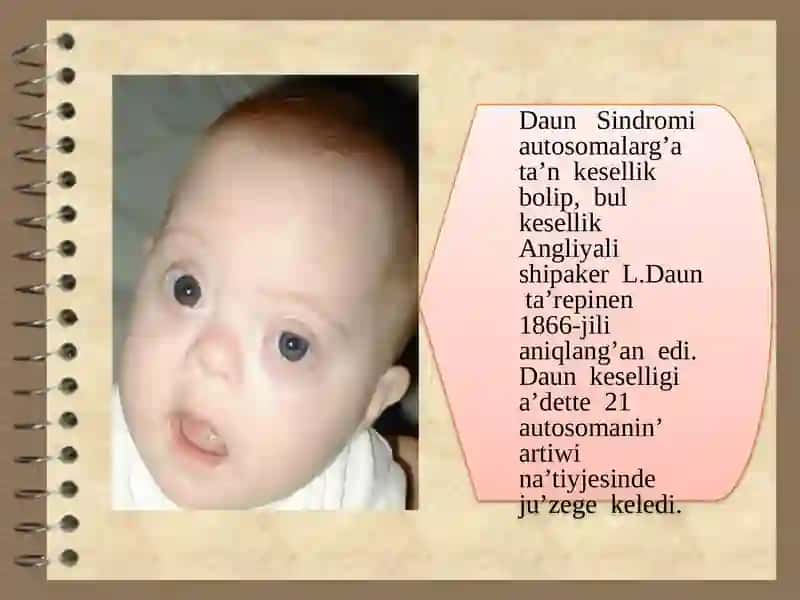 Xromosoma kesellikleri, Daun sindromi 2