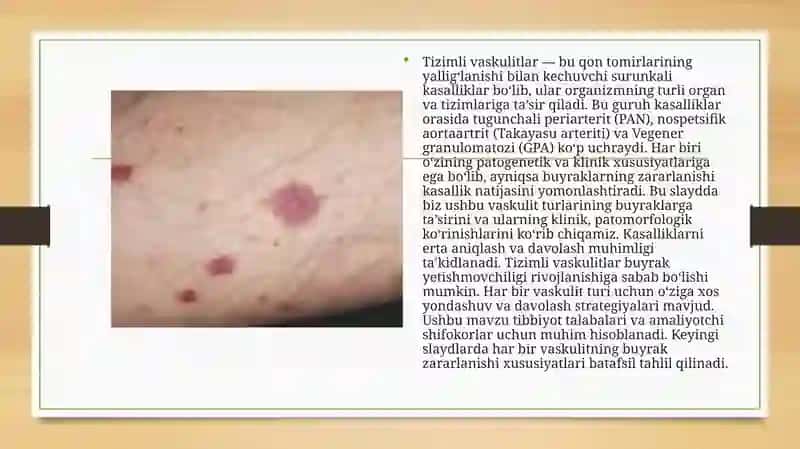 Tizimli vaskulitlar 2