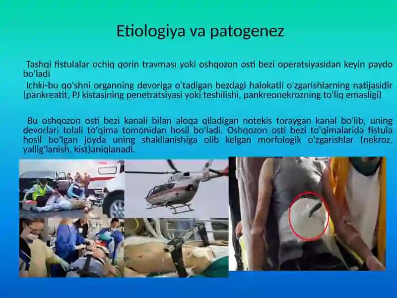 Oshqozon osti bezi fistulalari 2