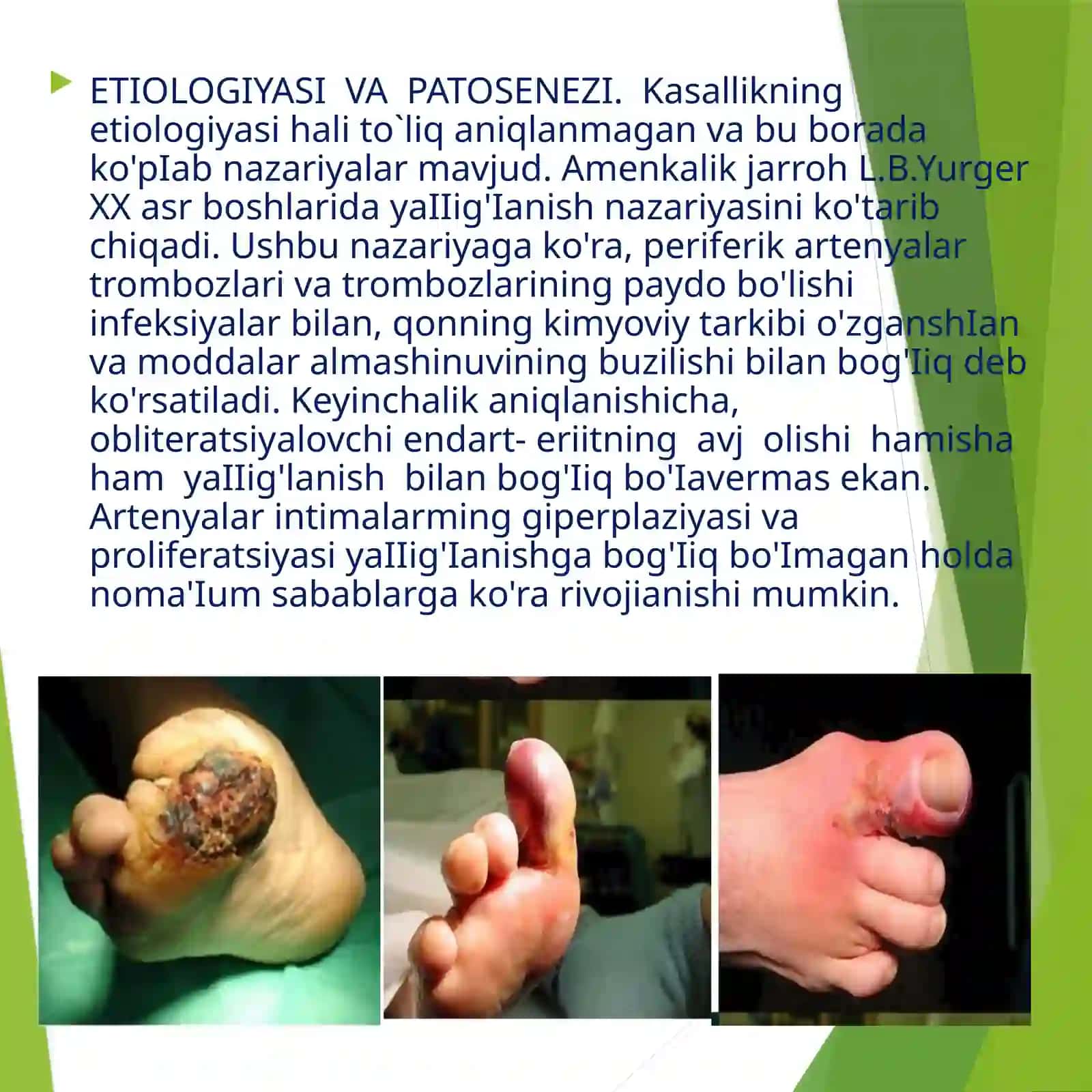 Obliteratsiyalovchi Endarterit 2