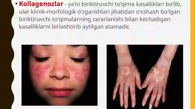 Kollagenoz 2