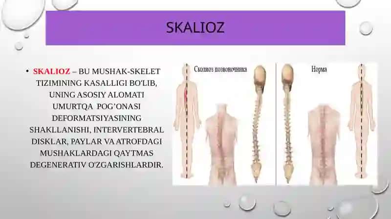 Skalioz kasalligi, tashxislash va kasallikni davolash usullari 2